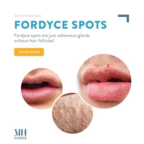 grain de fordyce|Fordyce Spots: Identification, Treatment, and More